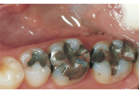 Bilde av begjæringen:Ein Verbot für Amalgam haltige Zahnfüllungen in der Zahnmedizin/Zahntechnik