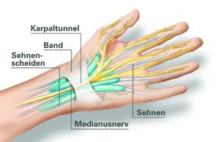 Bild der Petition Karpaltunnelsyndrom als Berufskrankheit anerkennen!