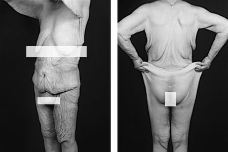 Bild der Petition: Krankenkassen verweigern ehemals Übergewichtigen med. Hilfe - Plastische Wiederherstellungschirurgie