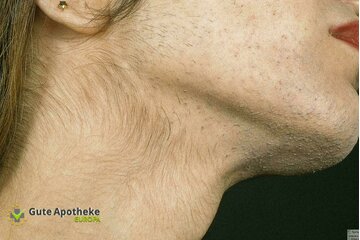 Bild der Petition Wir wollen  dass unsere Laser-Therapie von der Gesetzlichen Krankenkasse Übernommen wird